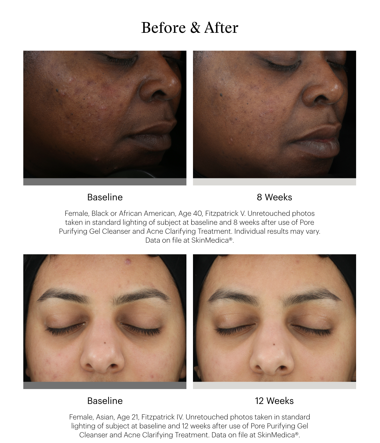 SkinMedica Acne Clarifying Treatment