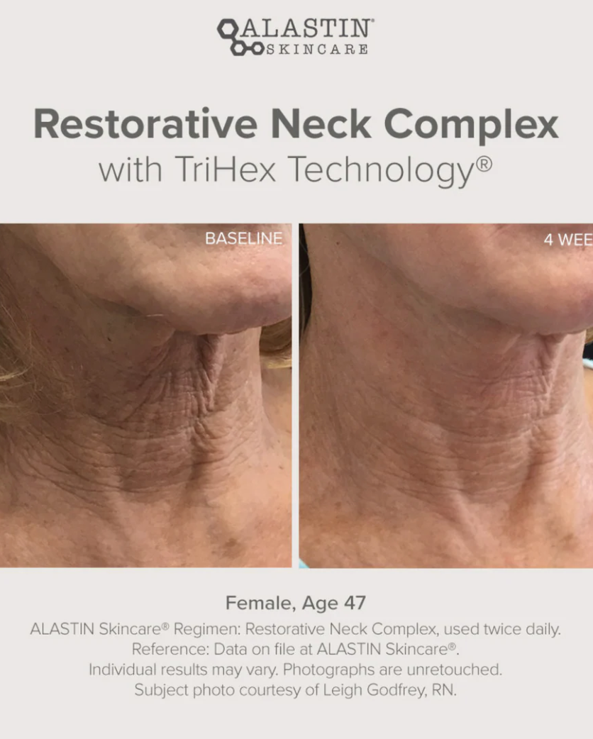 Alastin Restorative Neck Complex with TriHex Technology®