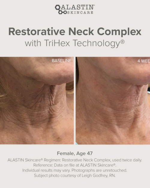 Alastin Restorative Neck Complex with TriHex Technology®